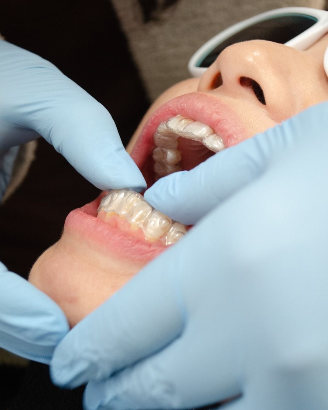 Kit Allineatori Completo