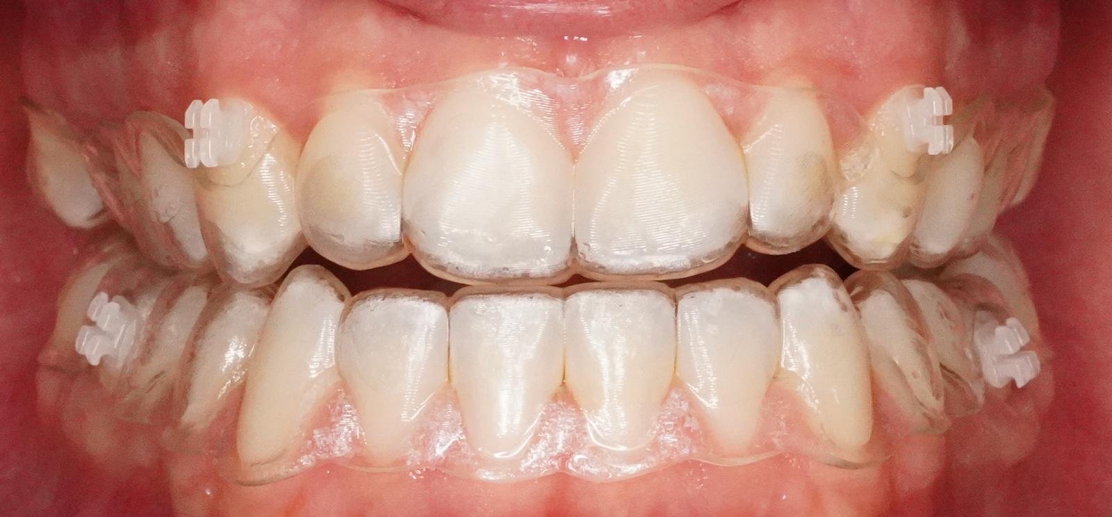 Dettaglio Sorriso e Allineatore